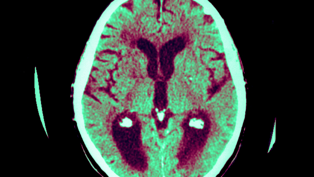 Alzheimer's brain scan (Getty)