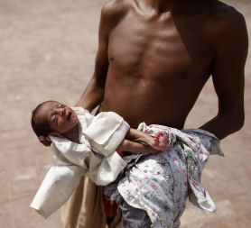 A severely malnourished baby is taken to the hospital by her brother in Pakistan's Muzaffargarh district of Punjab. (Reuters)
